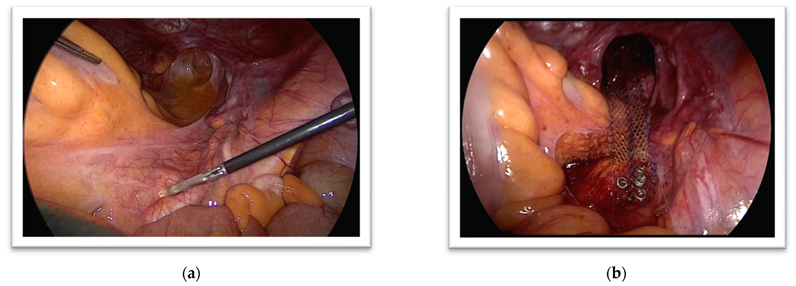 Gastroenterology Insights | Free Full-Text | Surgical Techniques for Rectal  Prolapse | HTML