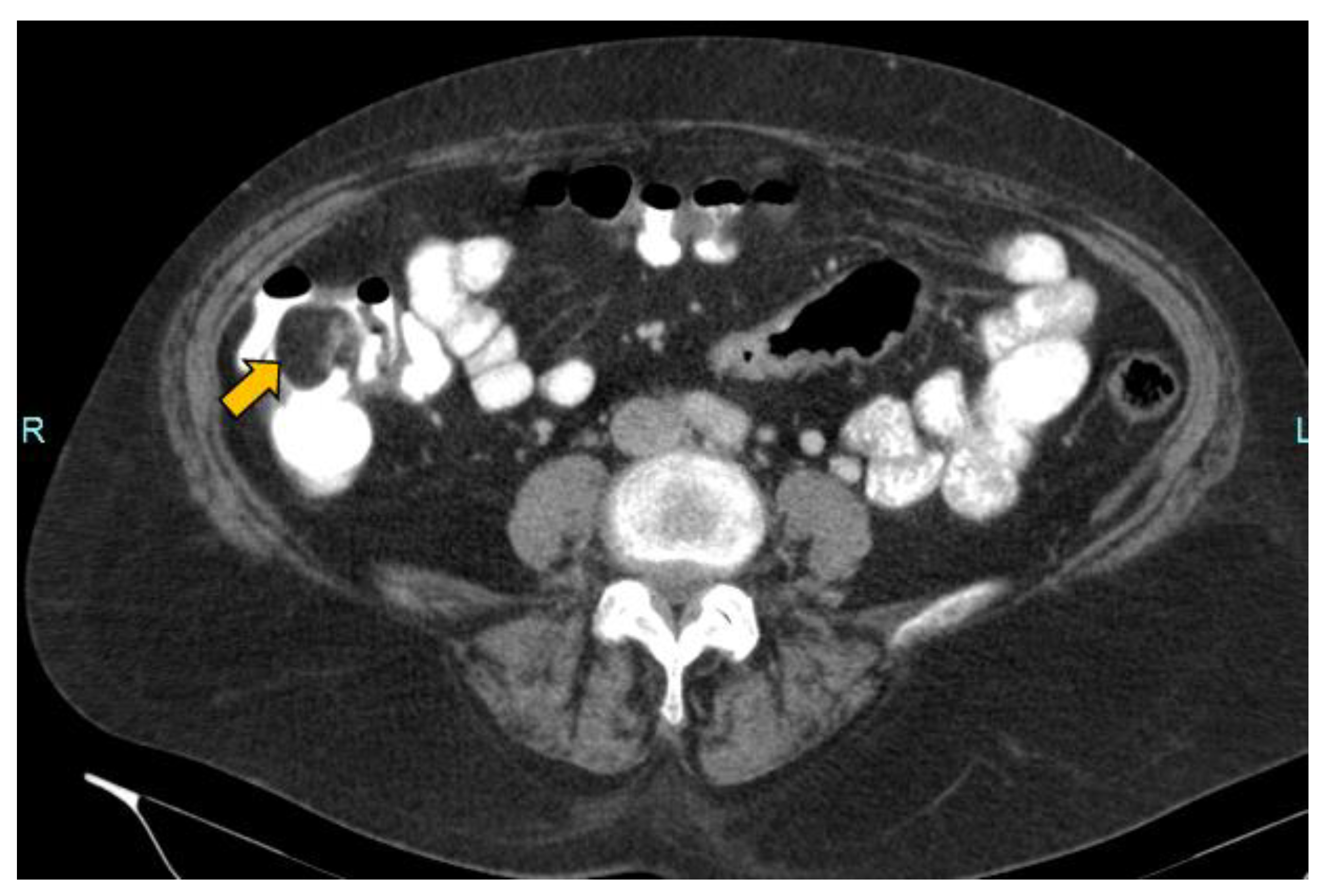 what-is-lipoma-ileocecal-valve-infoupdate