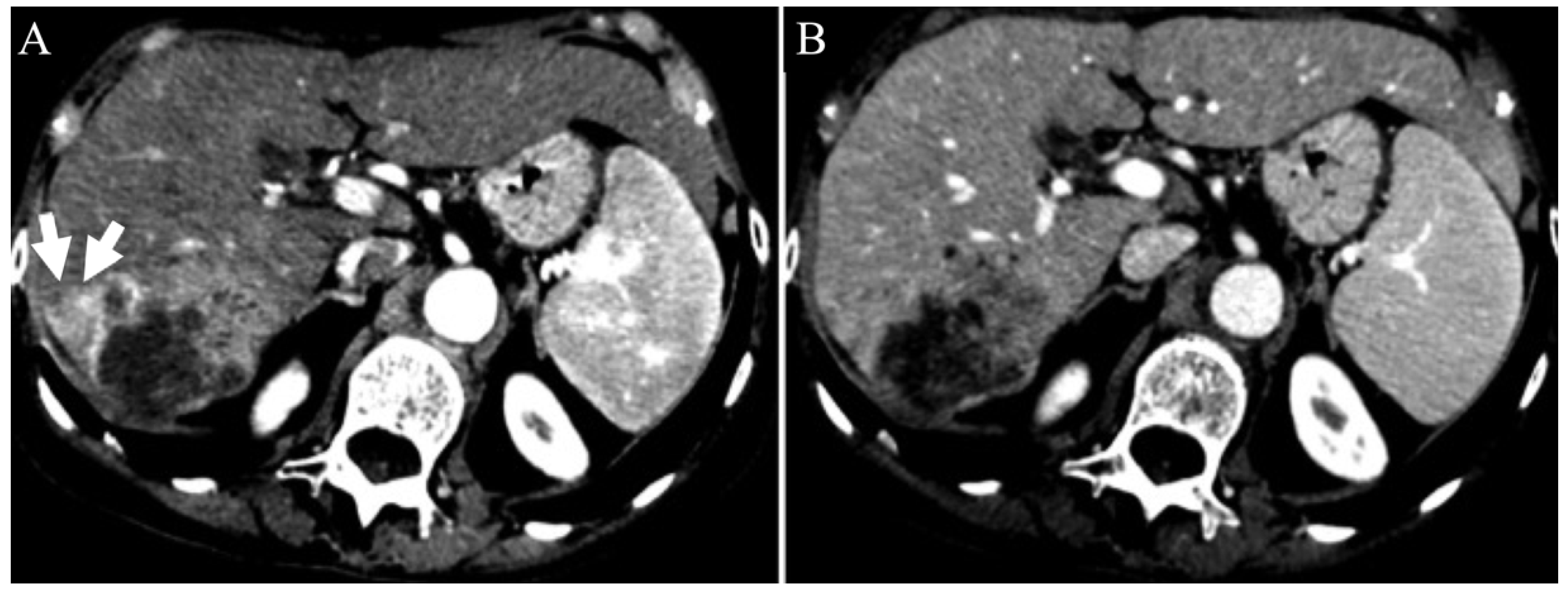 Gastroent 13 00028 g005 550