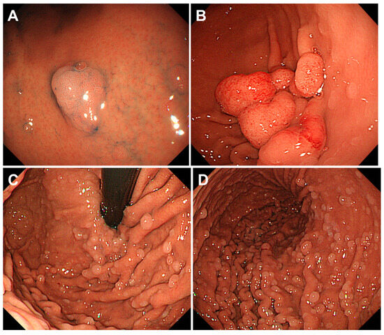 Differential Diagnoses and Management Approaches for Gastric