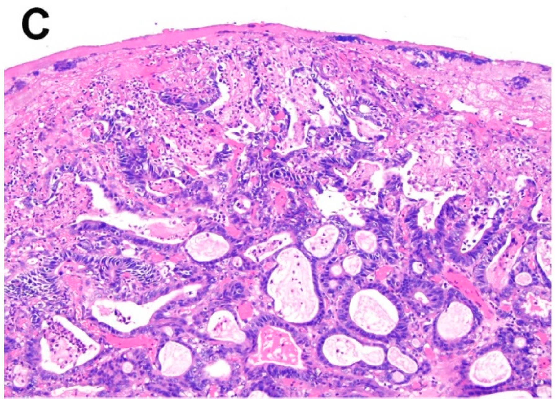 Gastrointestinal Disorders Free FullText Histopathology of Barrett