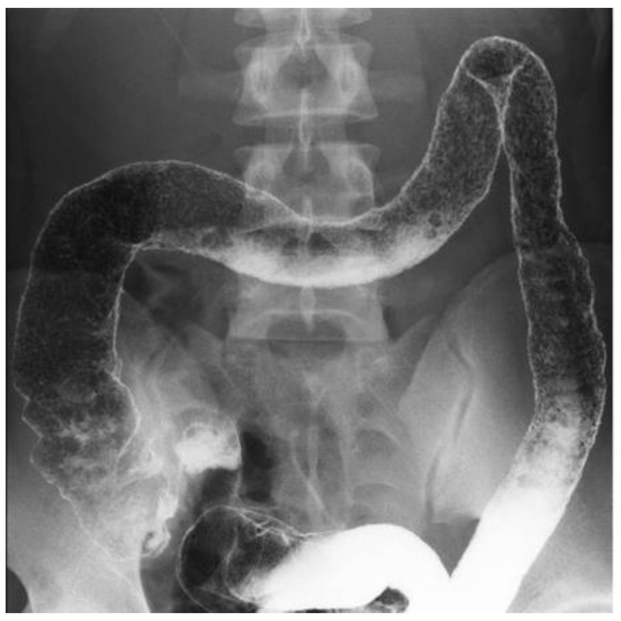 Gastrointestinal Disorders Free FullText Infliximab and Plant