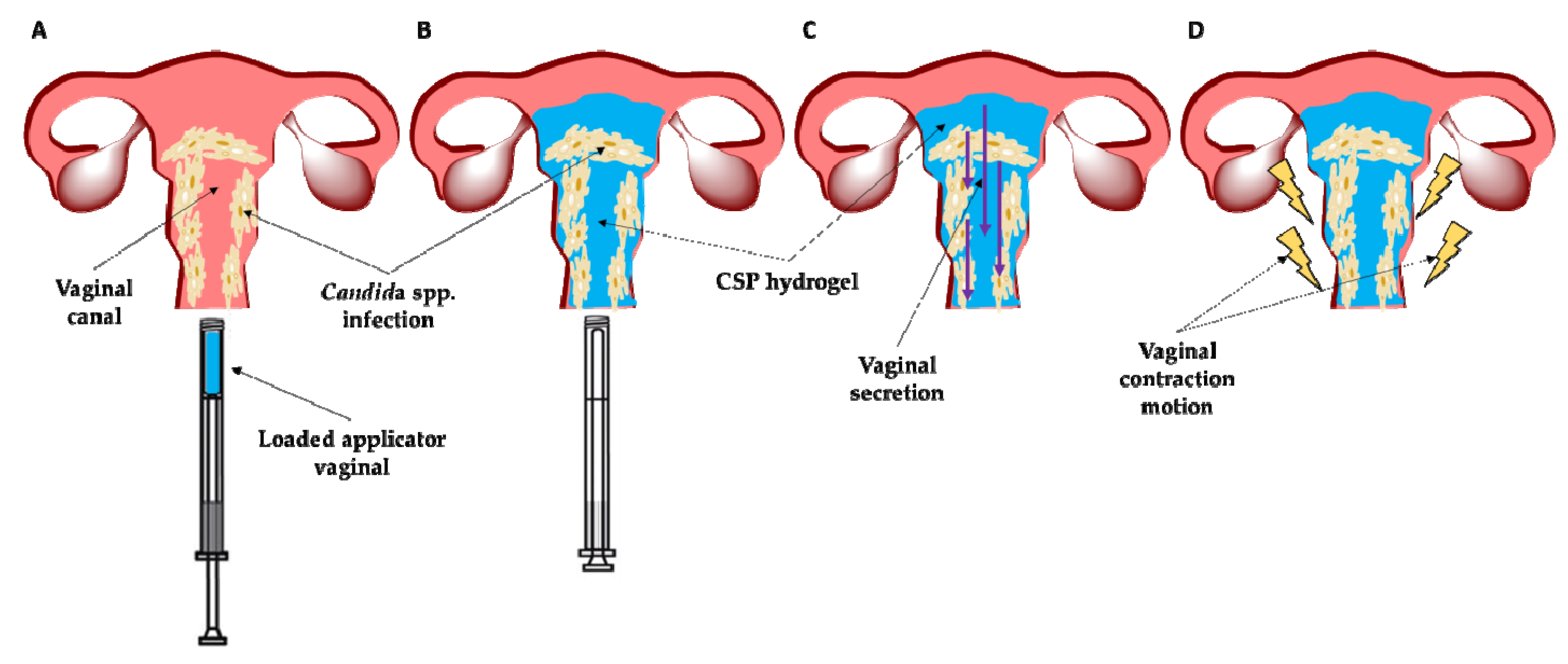 Candidom sau condilom - Condiloame vaginal