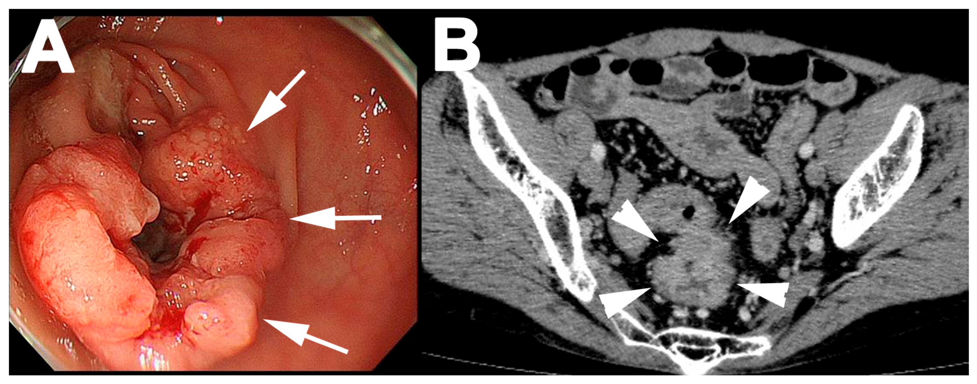 rectal tumor