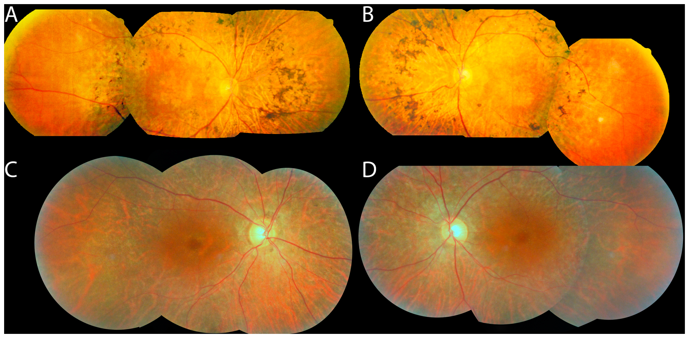Genes | Free Full-Text | The Genetic Basis of Pericentral Retinitis