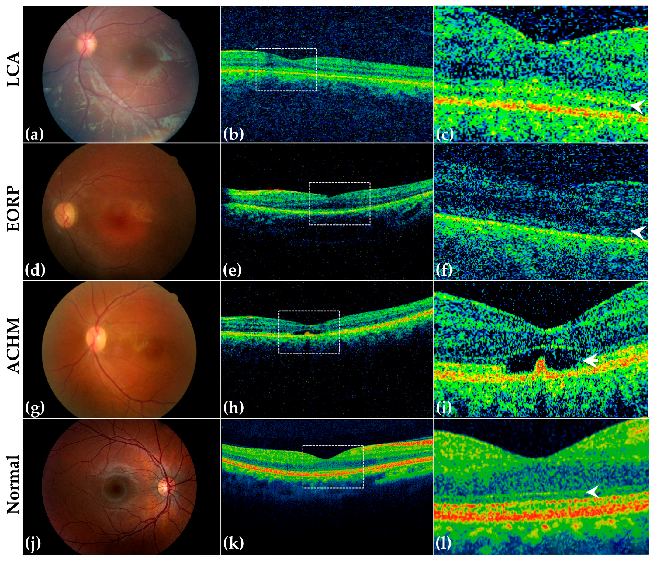 Genes Free Full Text Clinical And Genetic Evaluation Of A Cohort Of Pediatric Patients With Severe Inherited Retinal Dystrophies Html