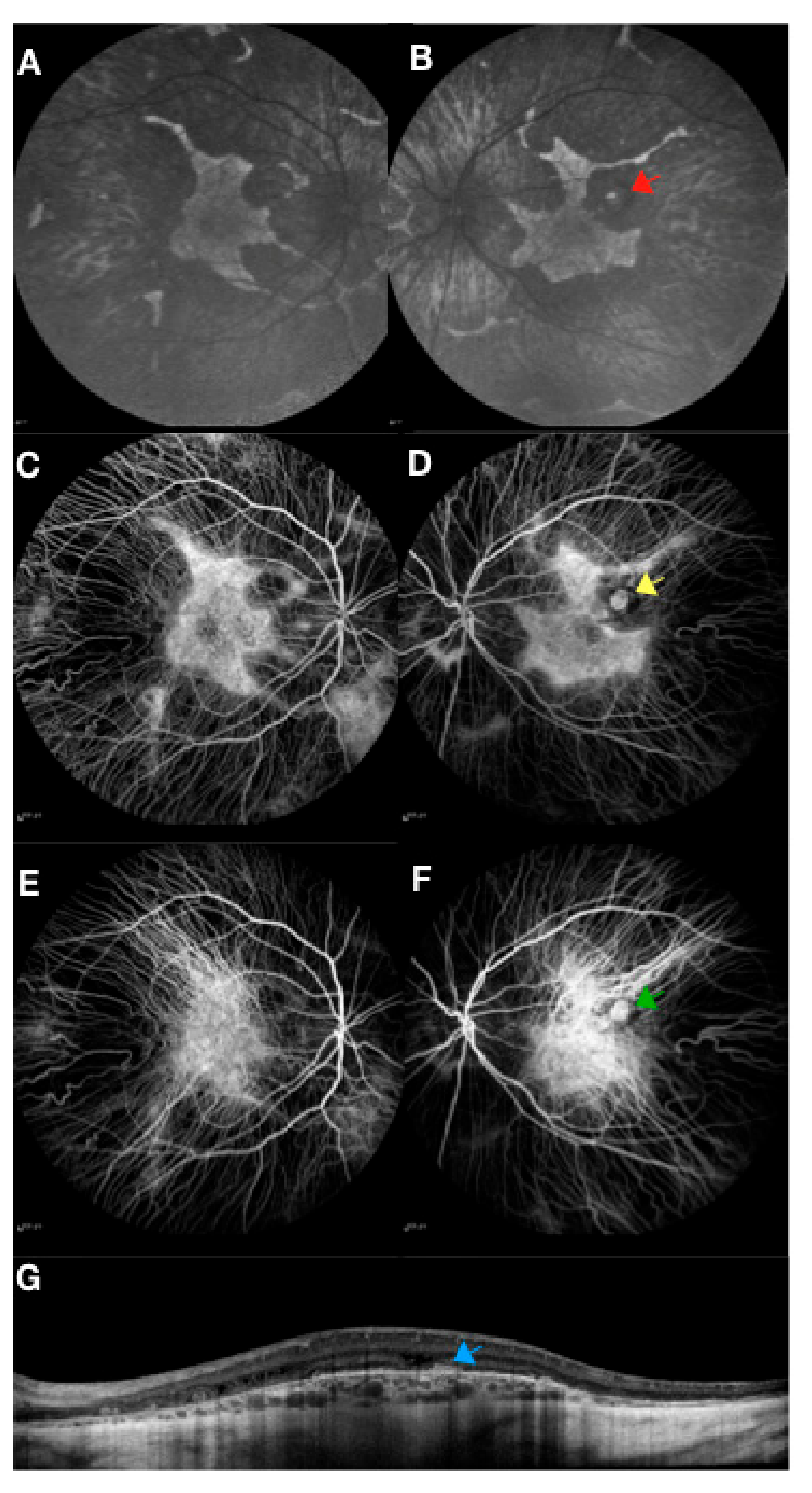 Genes Free FullText Molecular Therapies for Choroideremia