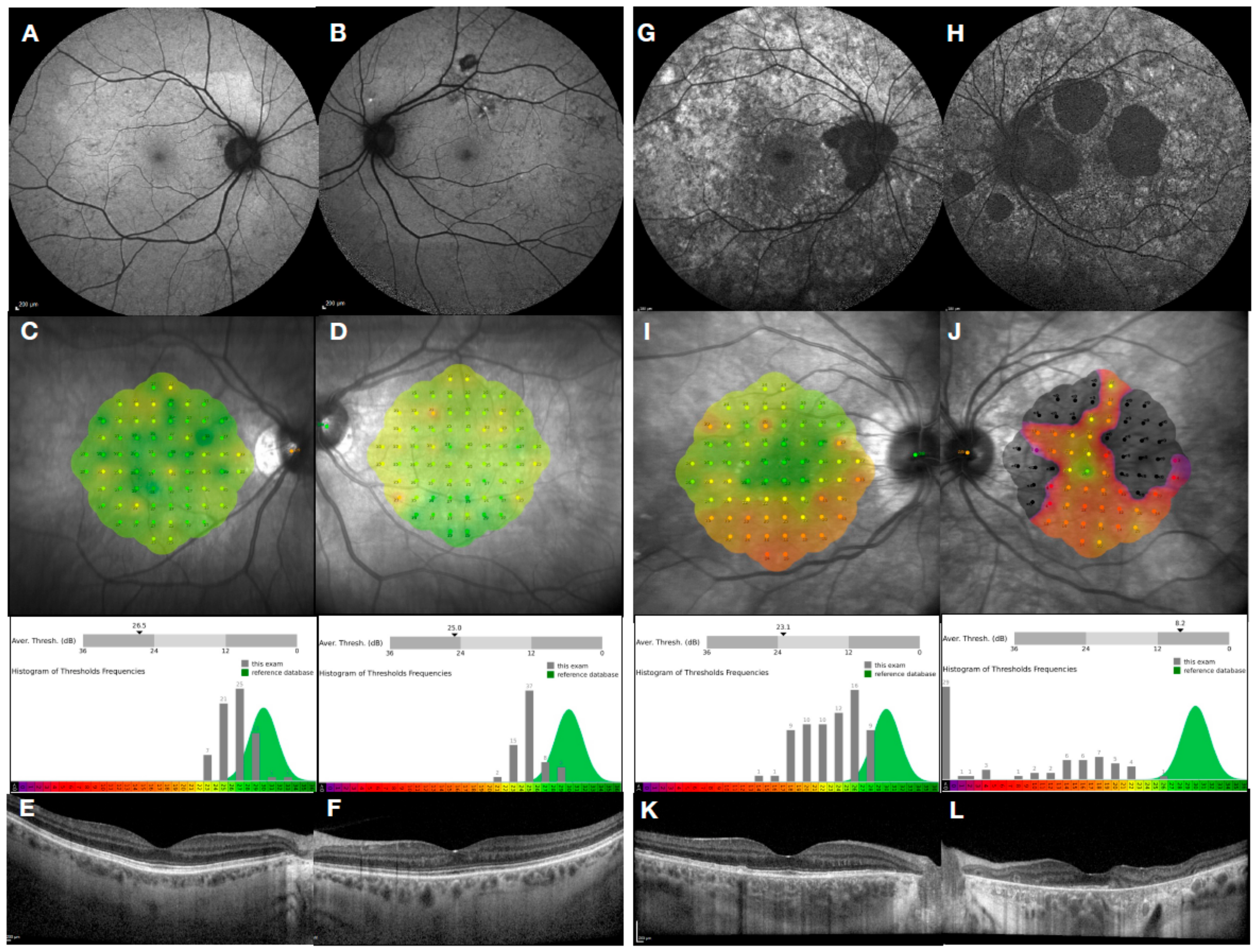 Genes Free FullText Molecular Therapies for Choroideremia