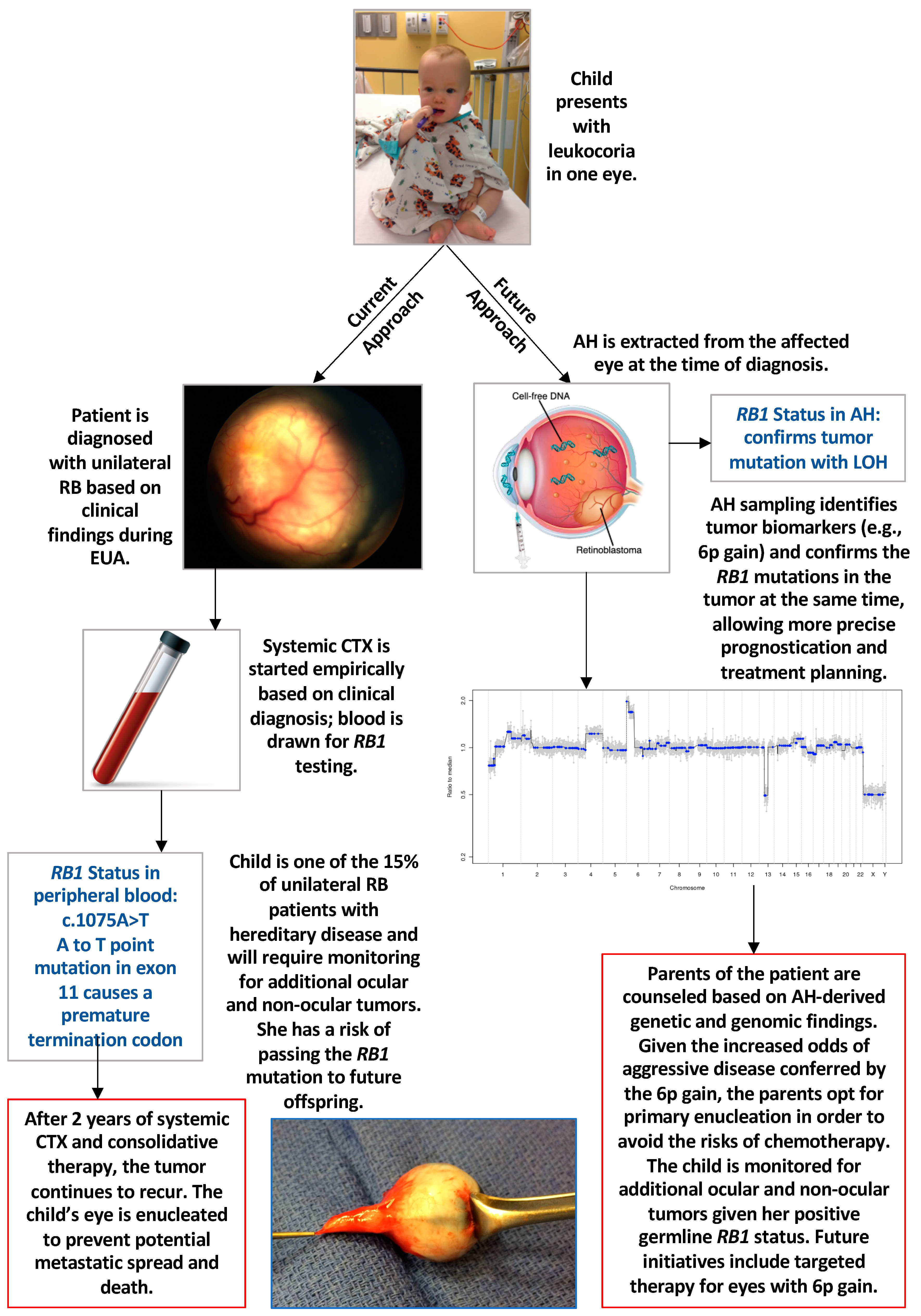 Retinoblastoma Treatment - NCI