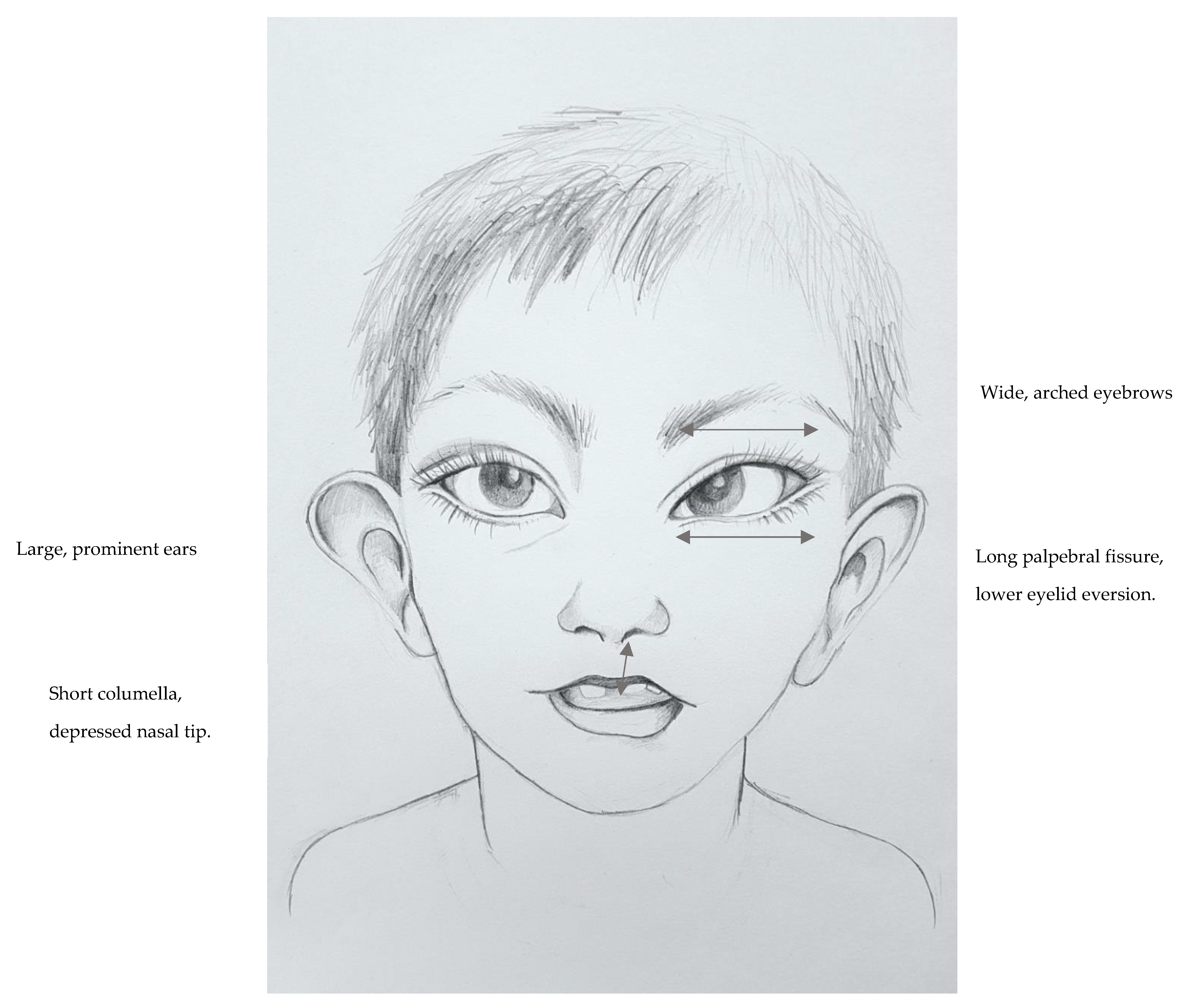 A Case of Rubinstein-Taybi Syndrome with Tetralogy of Fallot