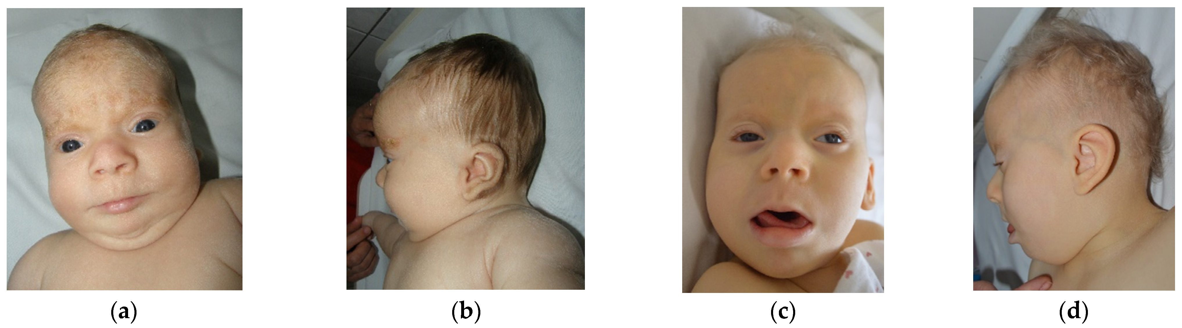 Figure 2. [Dorsal (A) and palmar (B)]. - GeneReviews® - NCBI Bookshelf