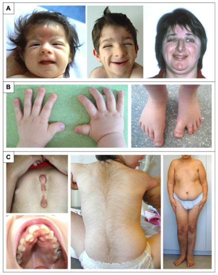 Rubinstein–Taybi syndrome: clinical and molecular overview, Expert Reviews  in Molecular Medicine