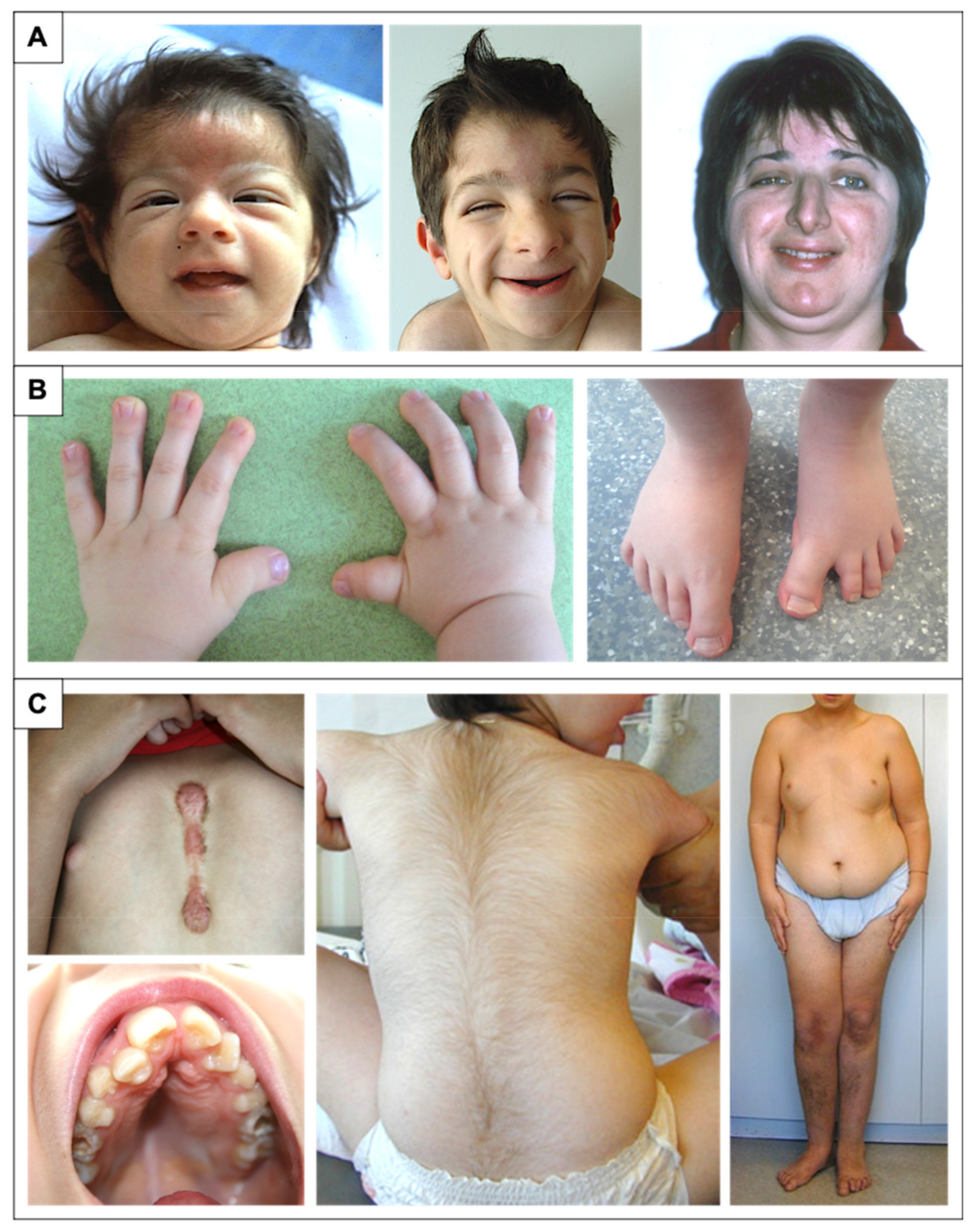 Fetal phenotype of Rubinstein‐Taybi syndrome caused by CREBBP
