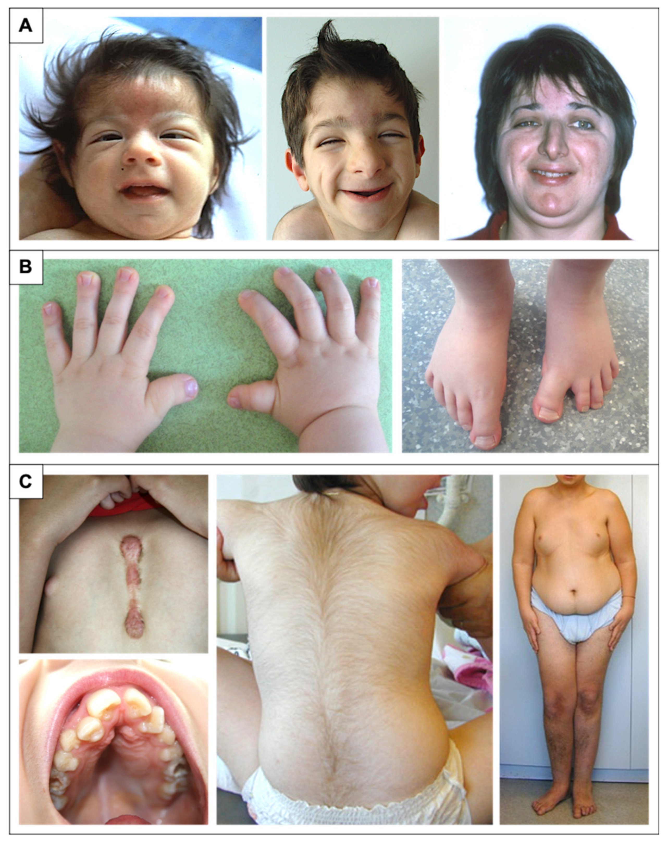 First case report of inherited Rubinstein-Taybi syndrome