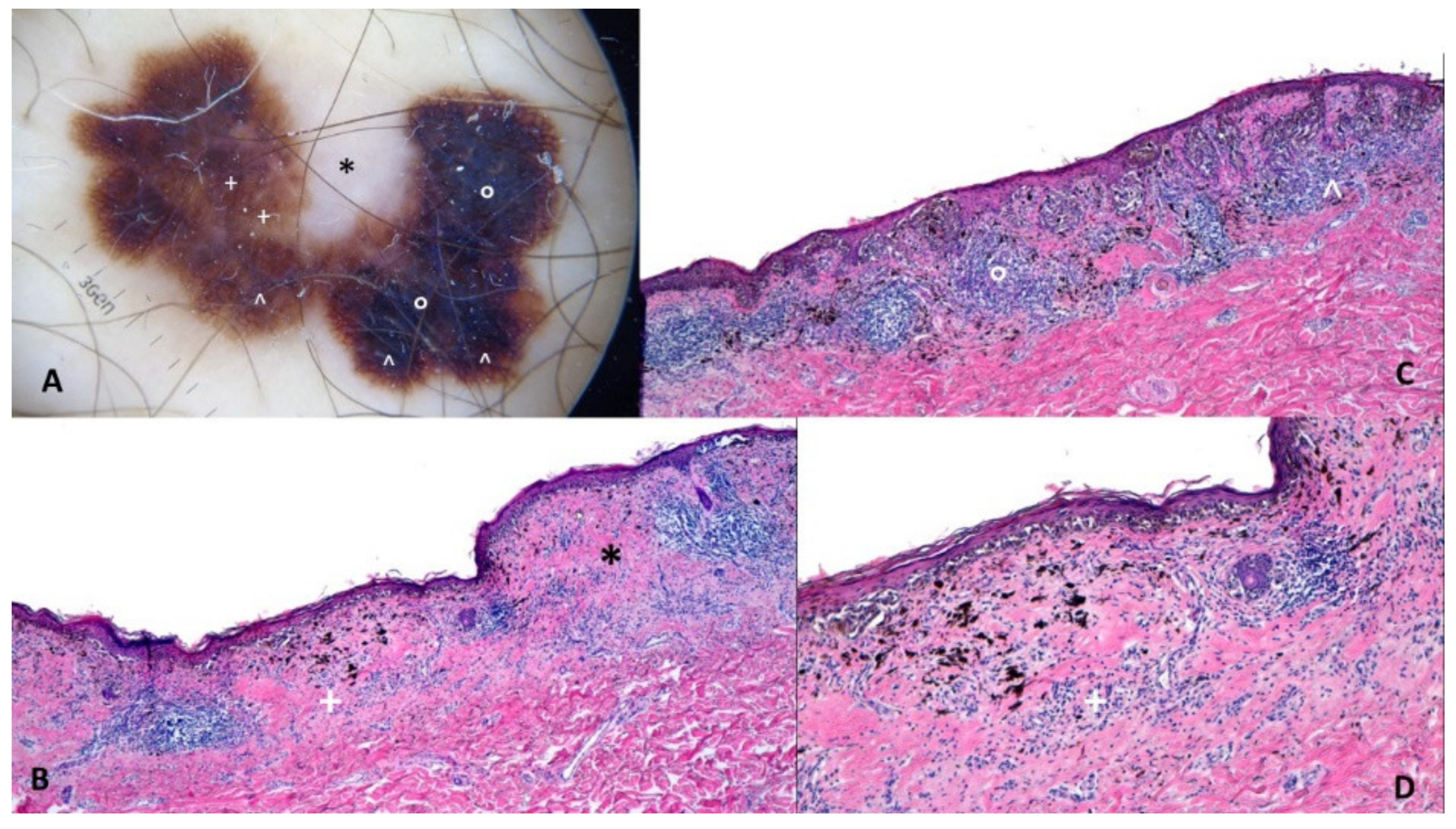 can mesothelioma cause bladder cancer telegra ph