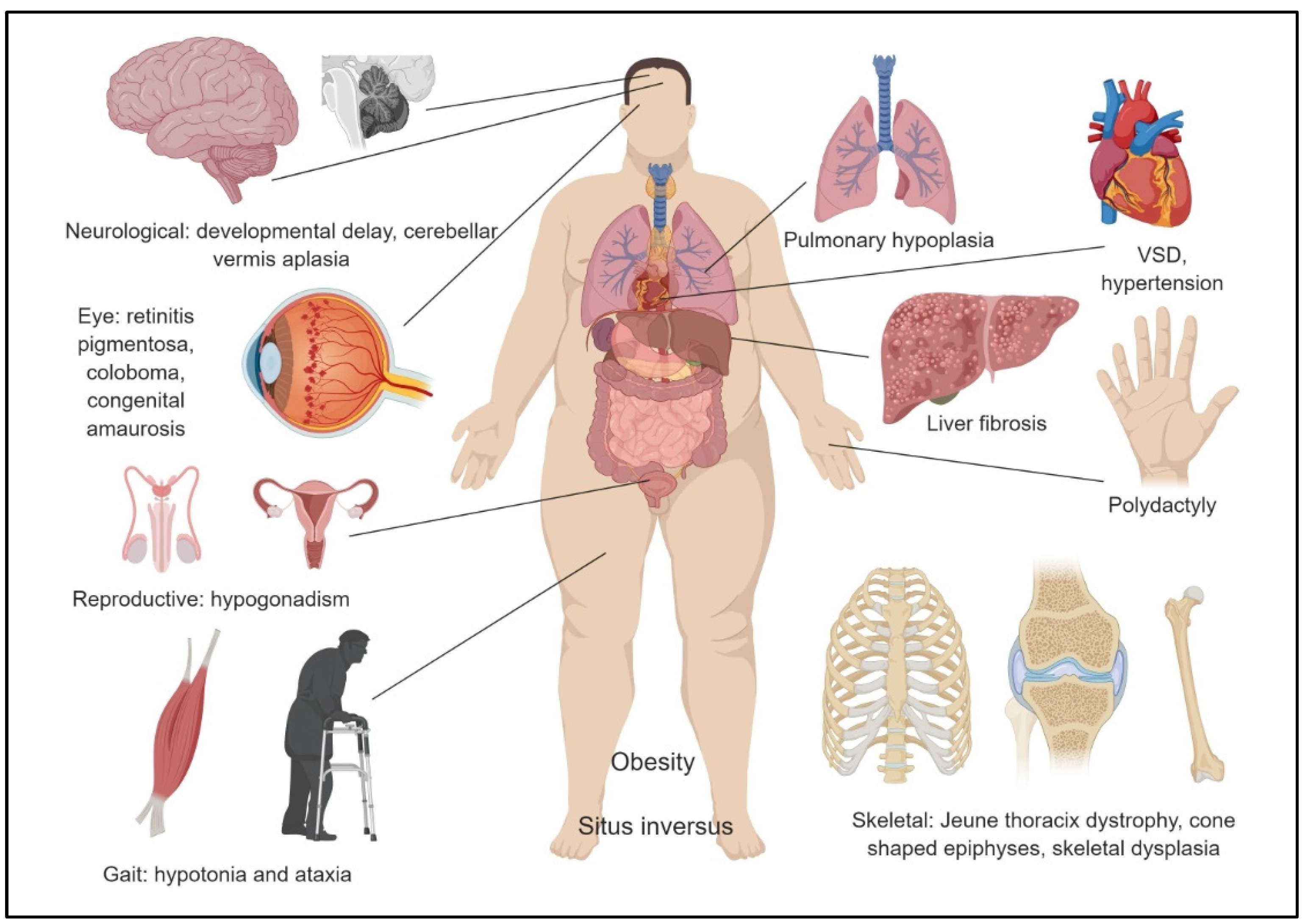 Nephronophthisis-Pathobiology and Molecular Pathogenesis of Nephronophthisis-Pathobiology and Molecular Pathogenesis of