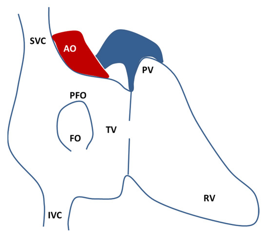 Pfo Pathophysiology The Genetic Landscape of Patent Foramen Ovale: A Systematic Review