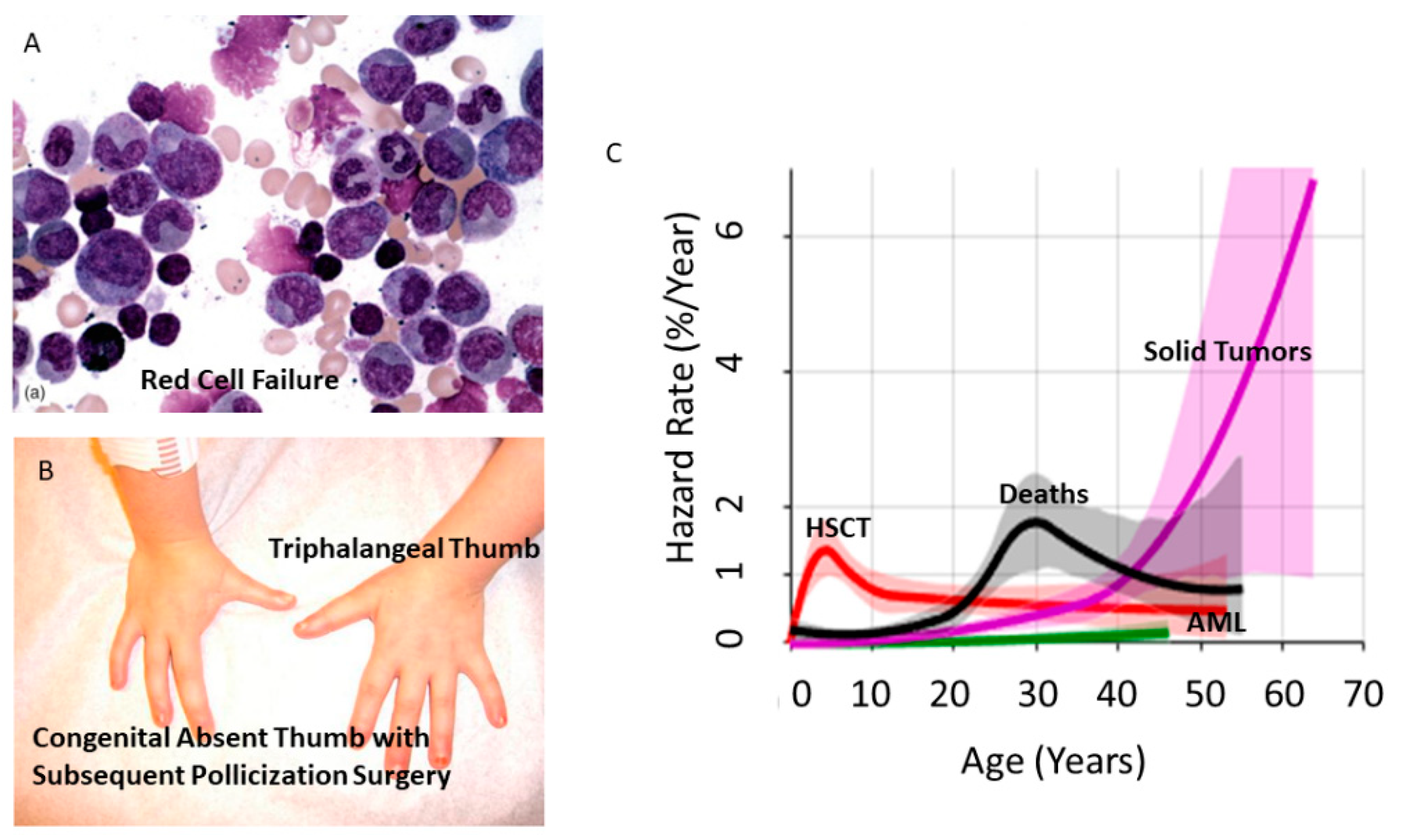 Genes Free FullText Early Onset Colorectal Cancer An Emerging