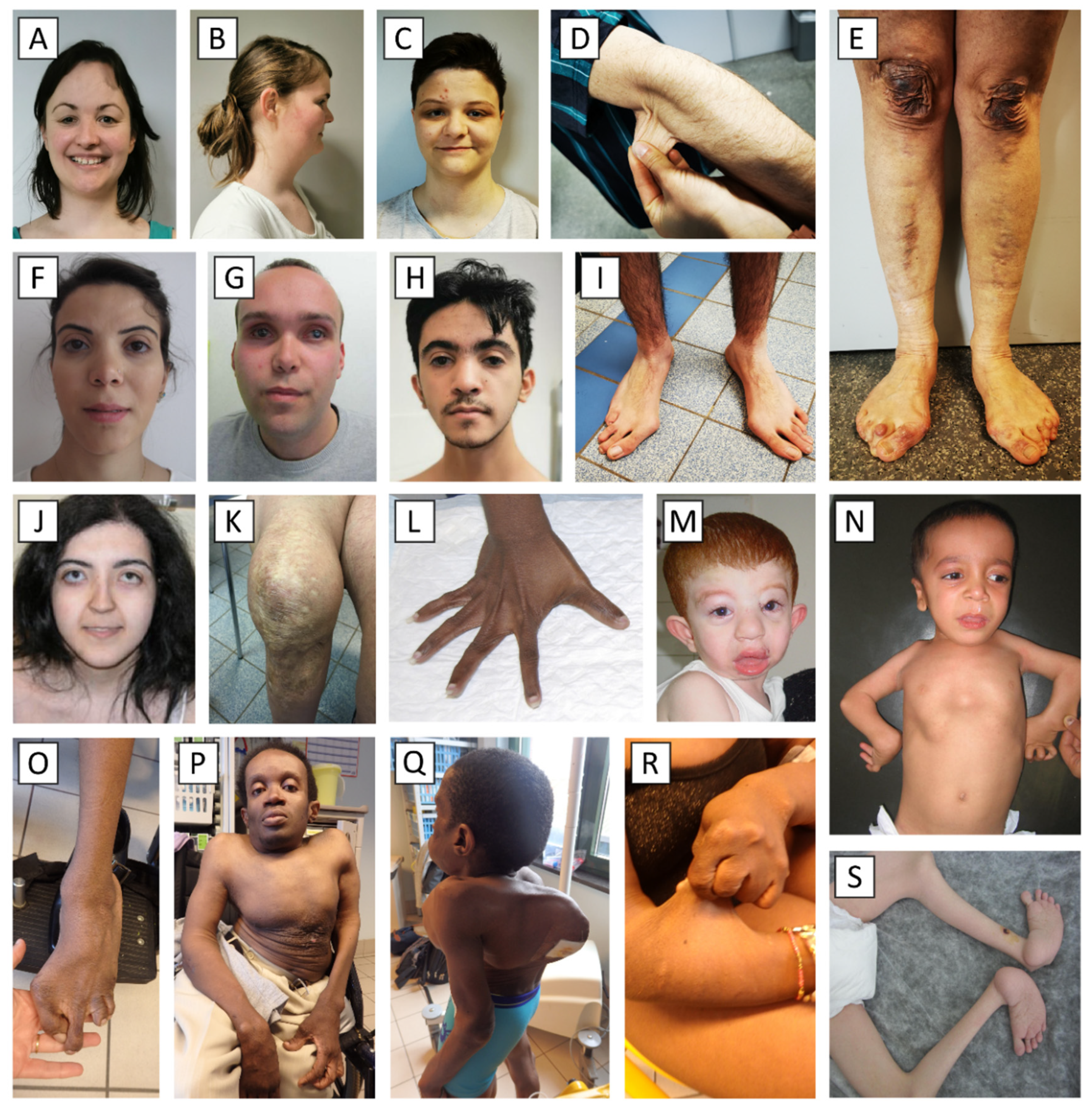Genes | Free Full-Text | The Ehlers–Danlos Syndromes against the  Backdrop of Inborn Errors of Metabolism