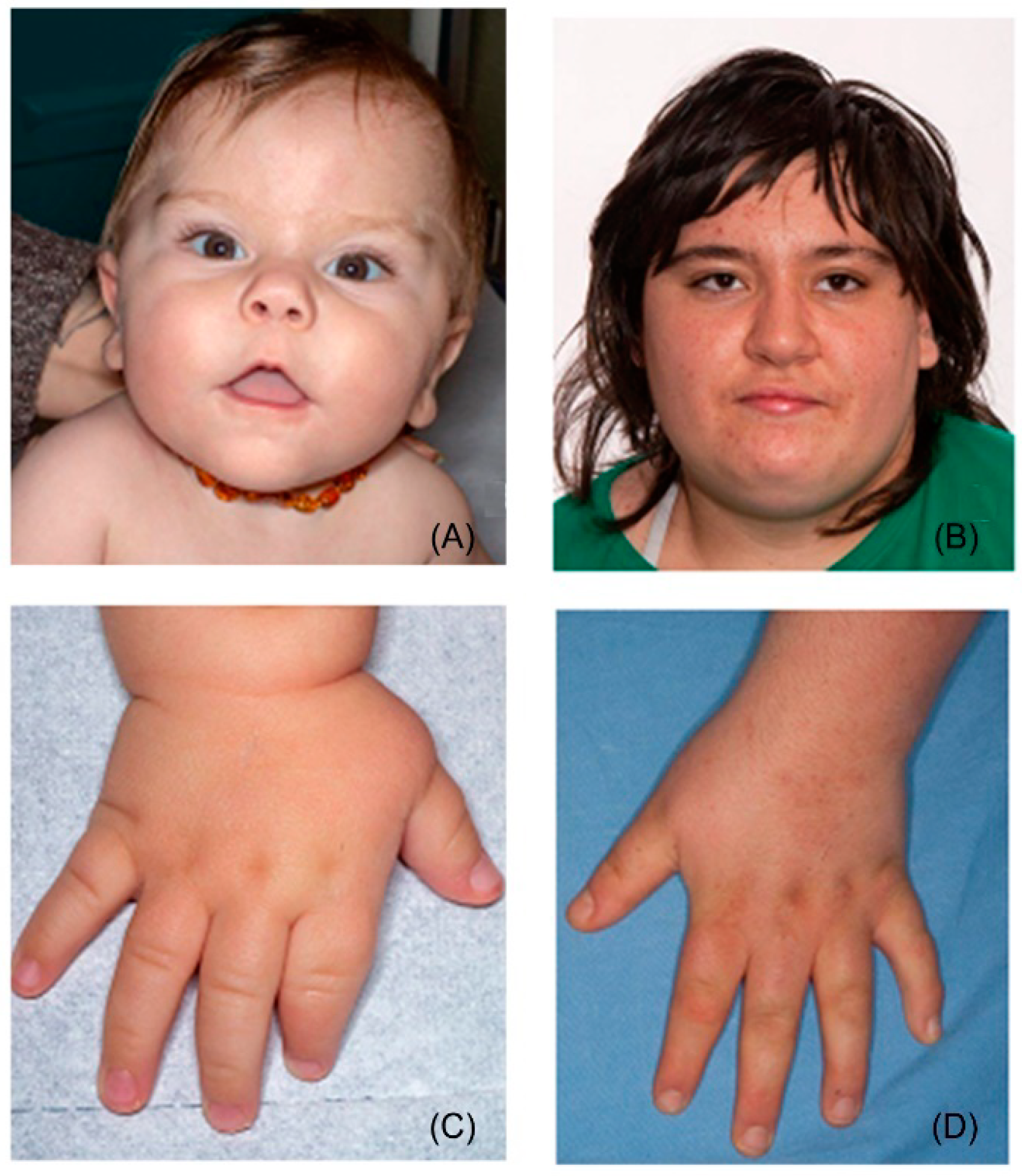 A mosaic maternal splice donor mutation in the EHMT1 gene leads to aberrant  transcripts and to Kleefstra syndrome in the offspring