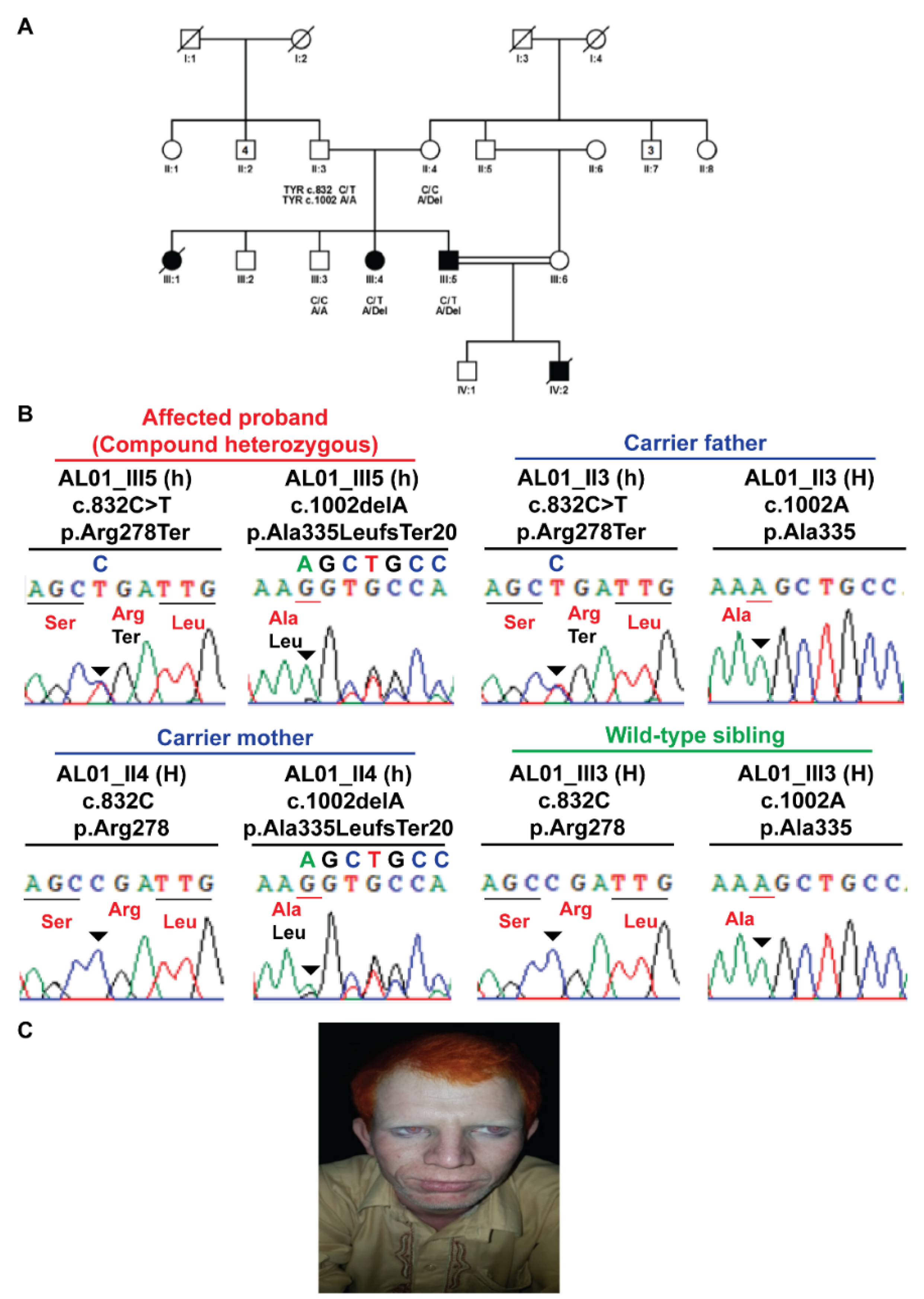 Genes | Free Full-Text | Delineating Novel and Known Pathogenic Variants in TYR, OCA2 and HPS-1 Genes in Eight Oculocutaneous Albinism (OCA) Pakistani Families Genes | Free Full-Text | Delineating Novel and Known Pathogenic Variants in TYR, OCA2 and HPS-1 Genes in Eight Oculocutaneous Albinism (OCA) Pakistani Families