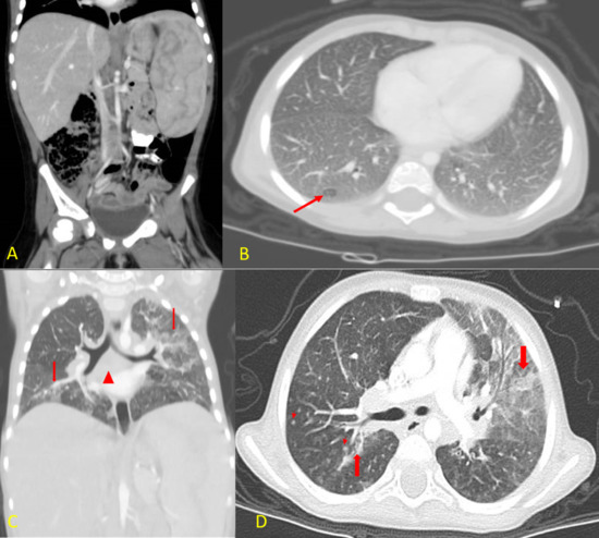 Niemann-Pick disease type B: HRCT assessment of pulmonary