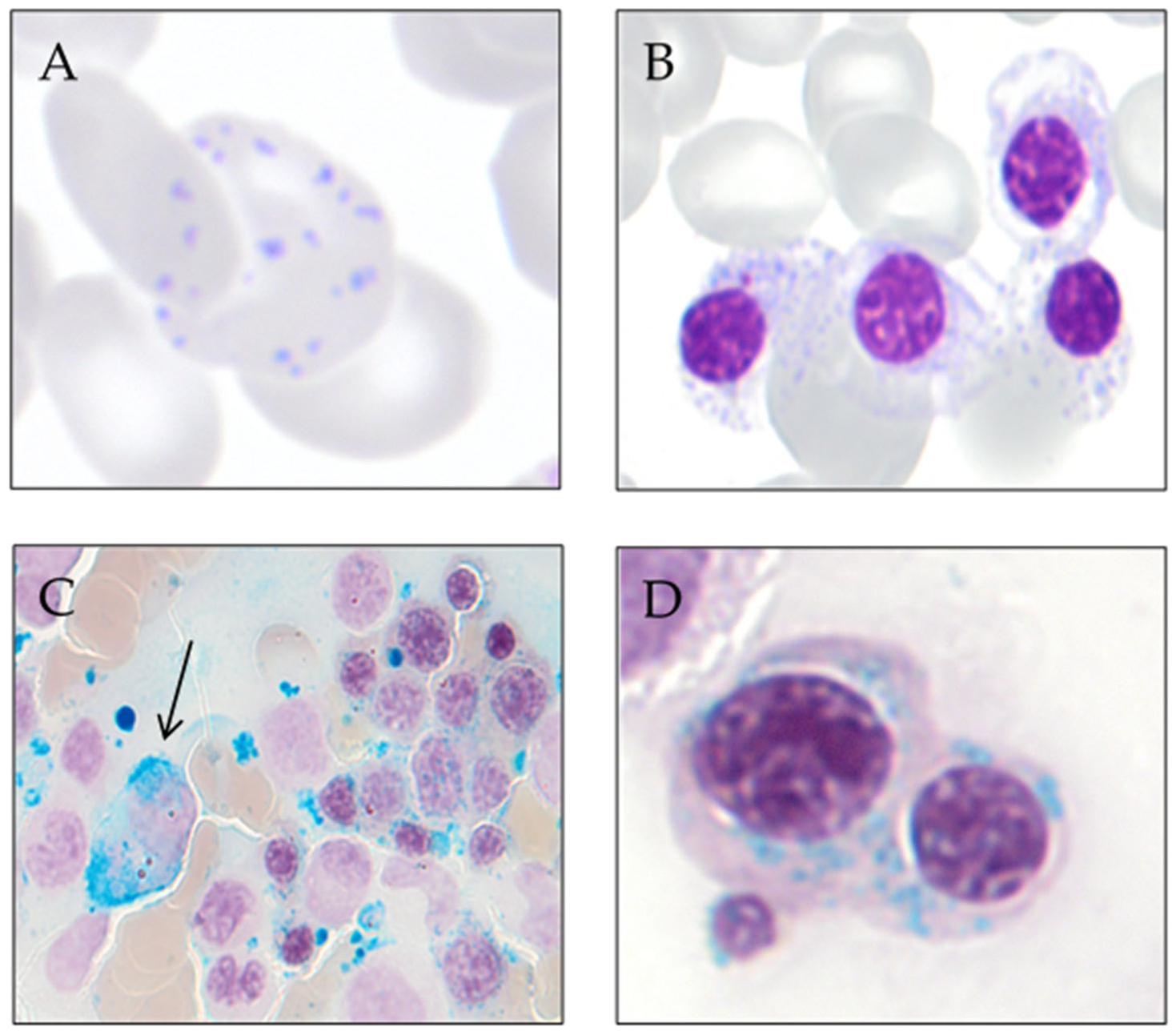 sideroblastic anemia pathophysiology