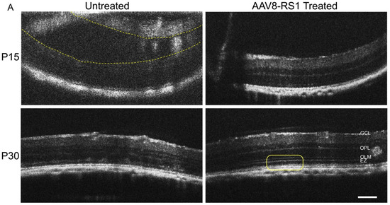 XLRS Rat with Rs1-/Y Exon-1-Del Shows Failure of Early Postnatal Outer ...