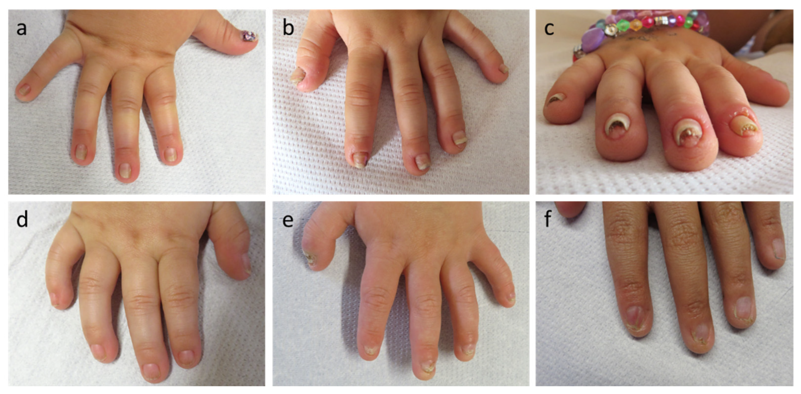 Genes | Free Full-Text | Congenital Nail Disorders among Children with  Suspected Ectodermal Dysplasias