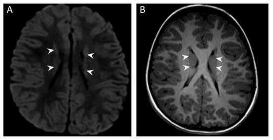 Autistic Behavior as Novel Clinical Finding in OFD1 Syndrome Autistic Behavior as Novel Clinical Finding in OFD1 Syndrome