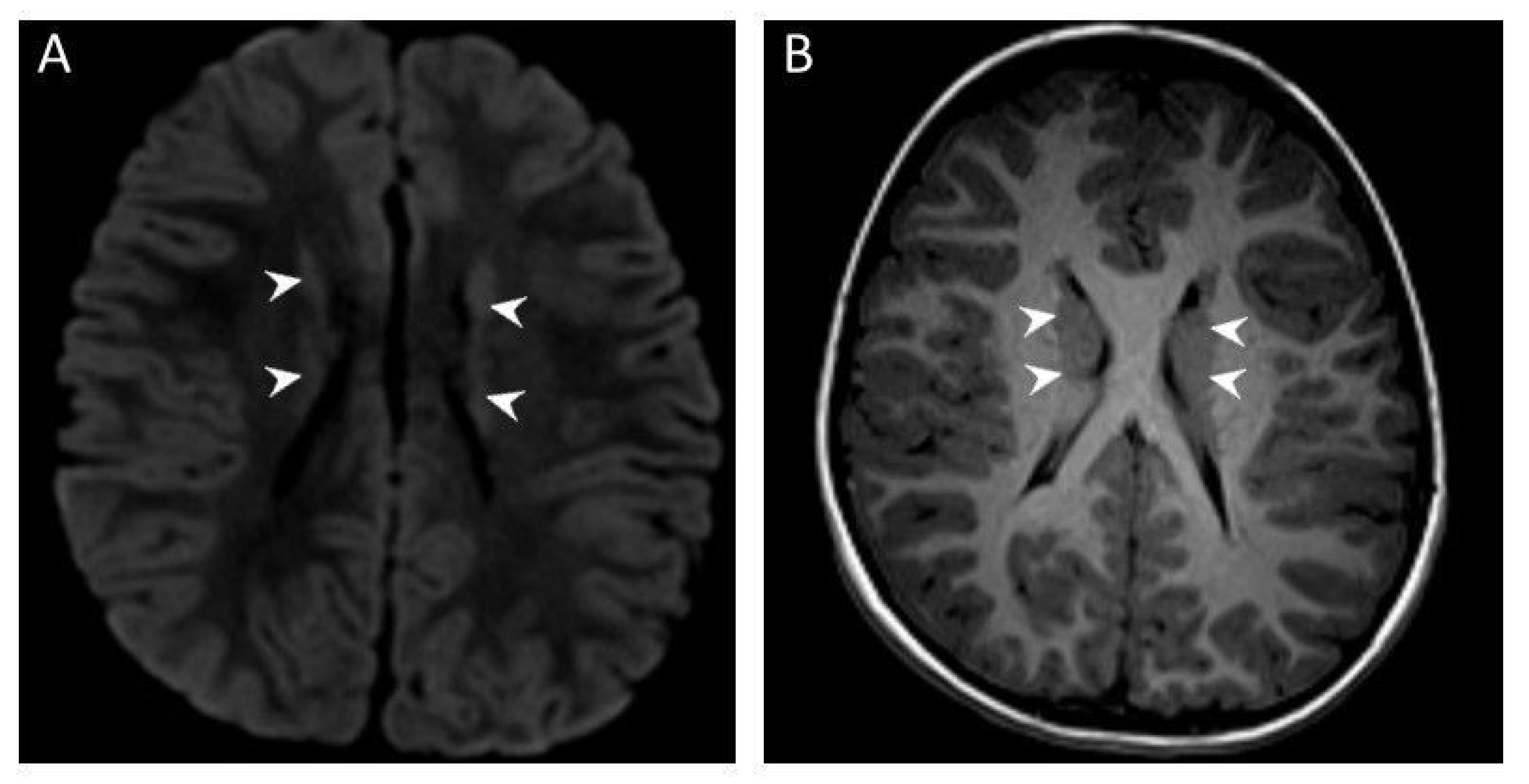 Autistic Behavior as Novel Clinical Finding in OFD1 Syndrome
