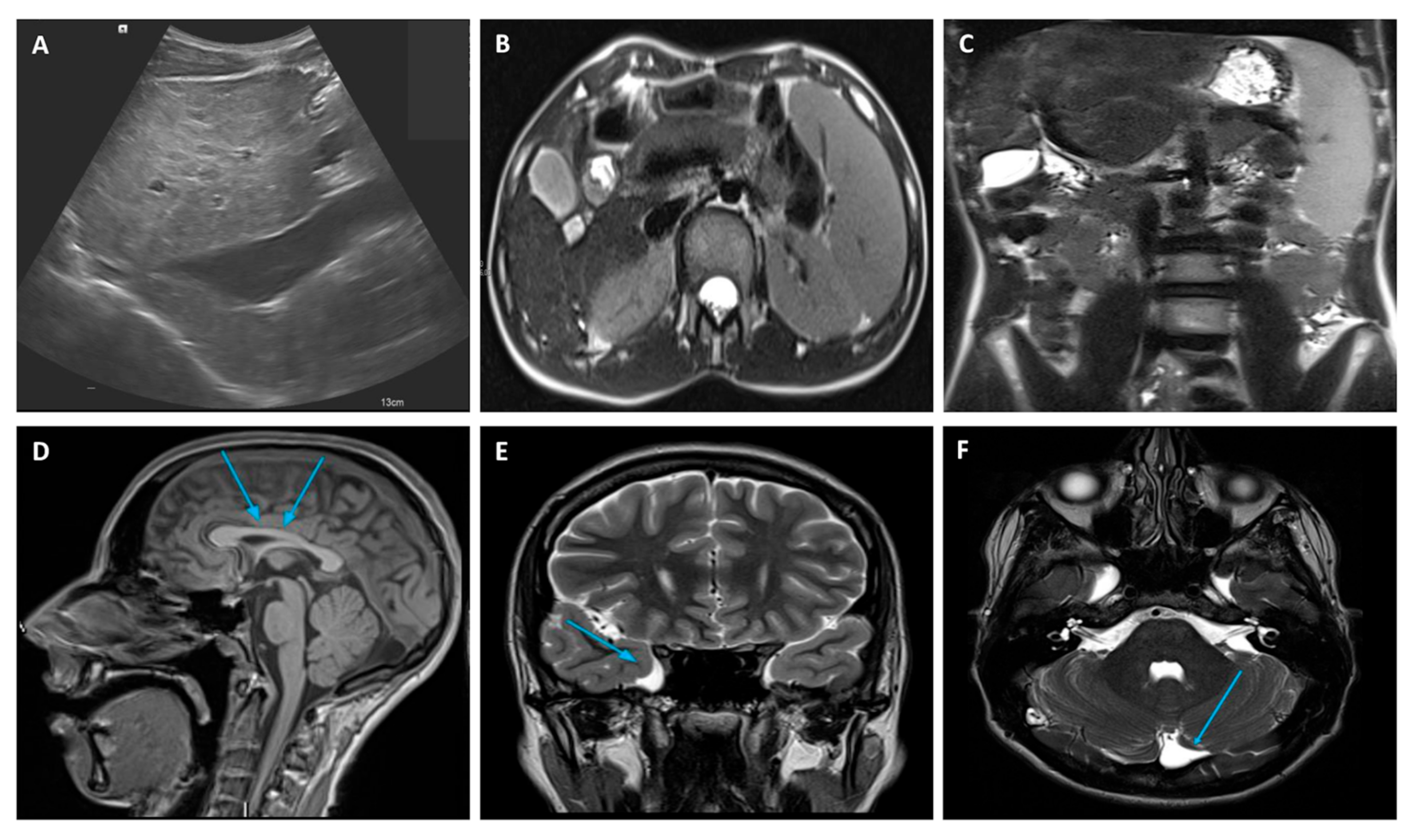 The Expanding Phenotype of ZTTK Syndrome Due to the