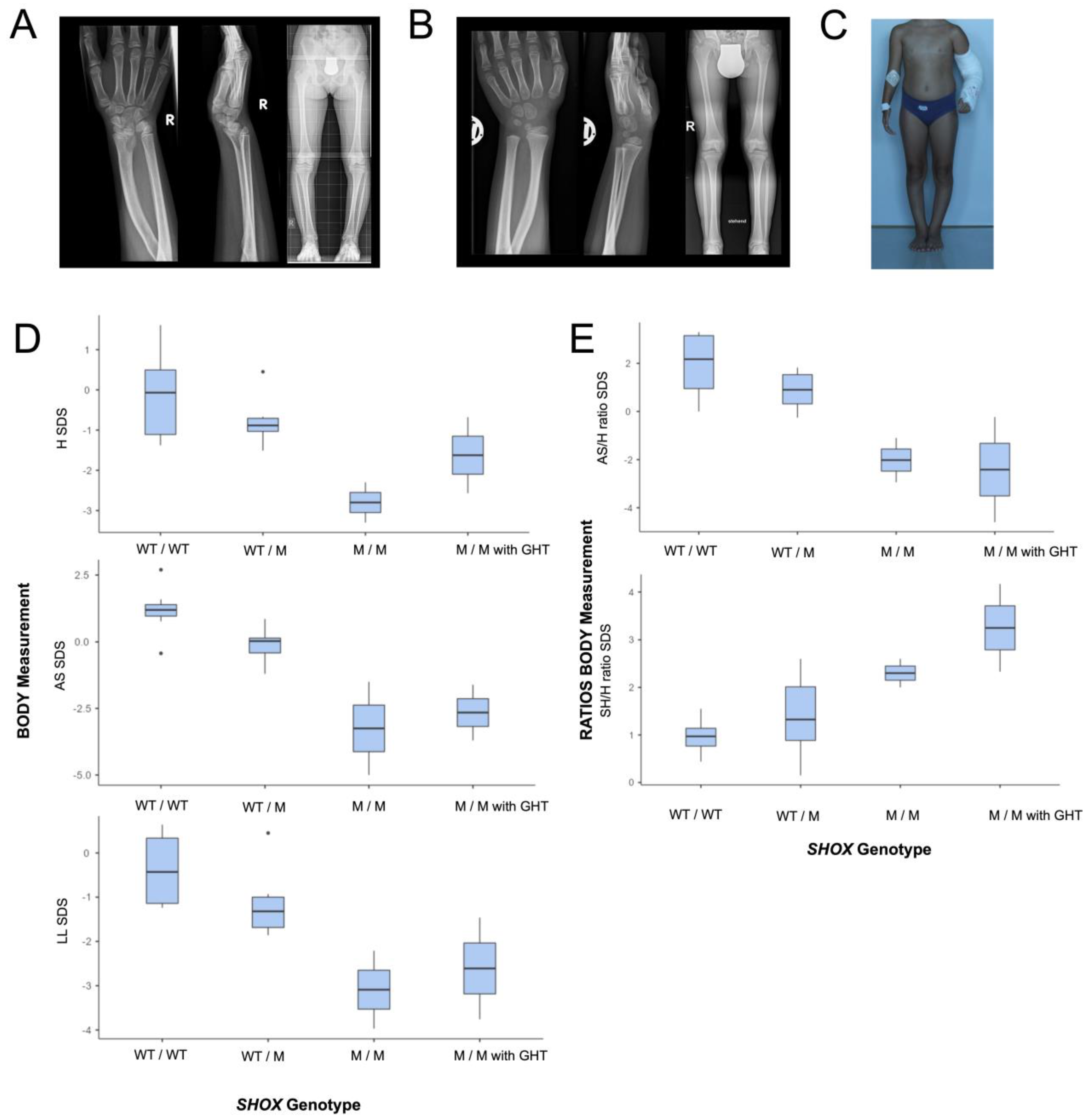 Leri Weill Dyschondrosteosis Caused by a Leaky Homozygous SHOX Splice Site Variant