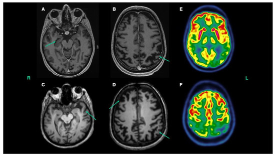 Young Onset Alzheimer's Disease Associated with C9ORF72