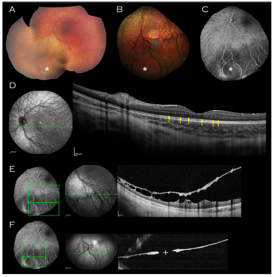 Retinoschisis Treatment Laser