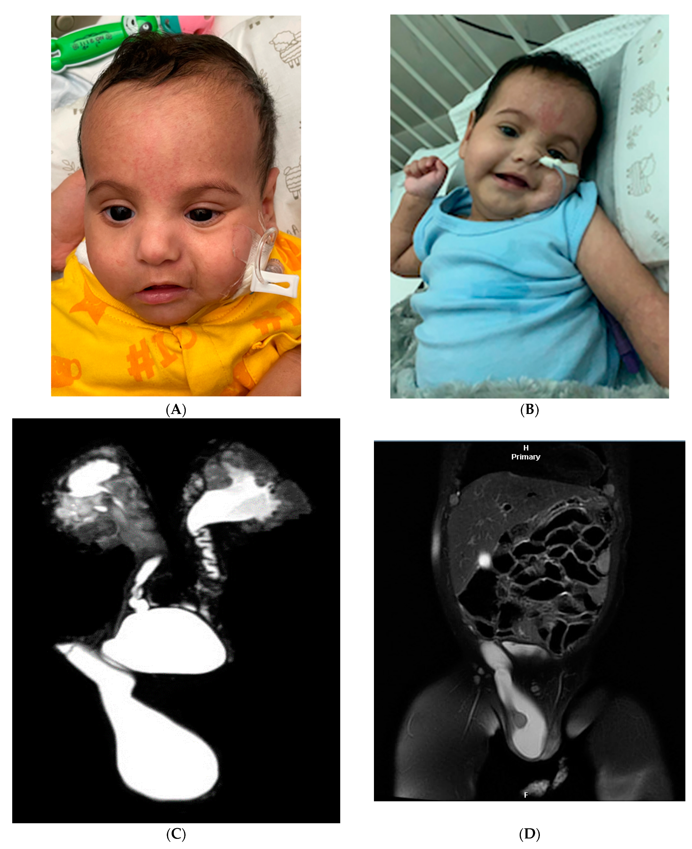 Interstitial Deletion of 3q21 in a Kuwaiti Child with