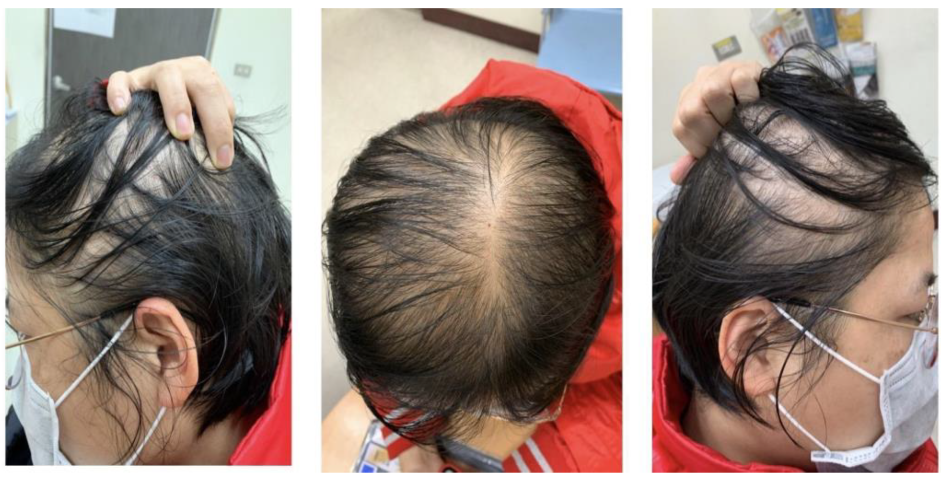 Can a woman have pattern baldness or androgenetic alopecia  hairmd