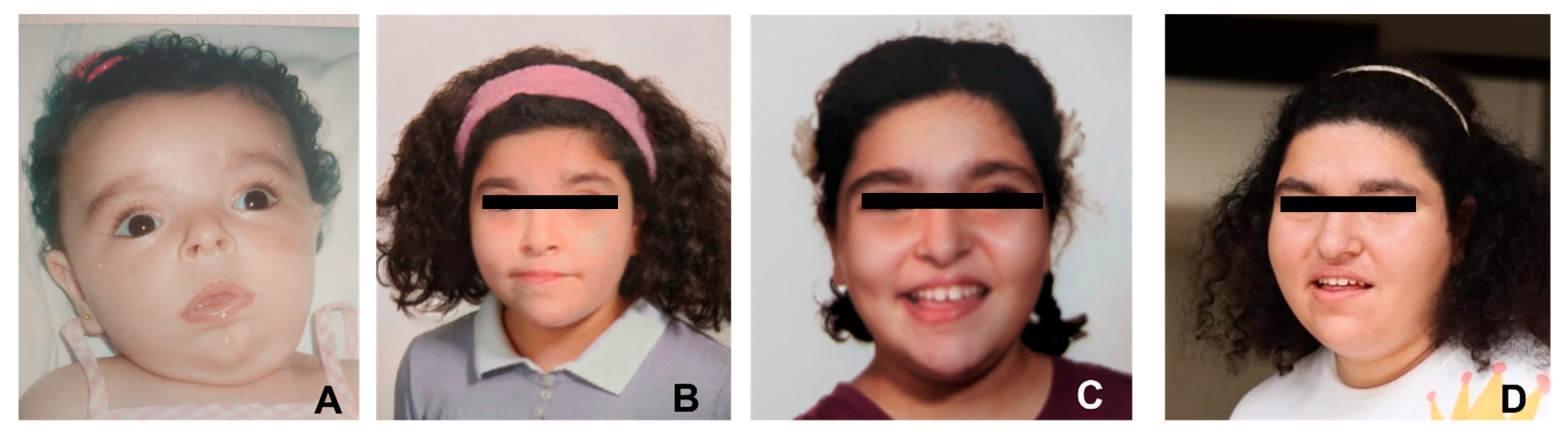 Clinical photos of the patients. (a) Case 1: Dysmorphic facial