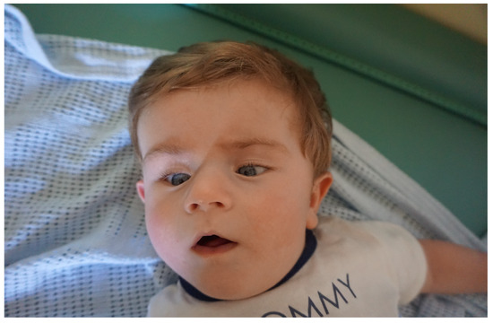 Further Delineation of Clinical Phenotype of ZMYND11 Variants in