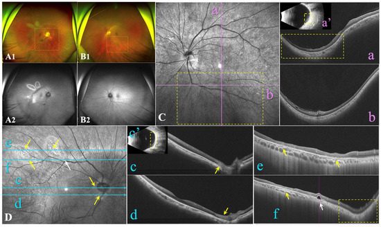 Mild Phenotypes of Gyrate Atrophy in a Heterozygous Carrier with One ...