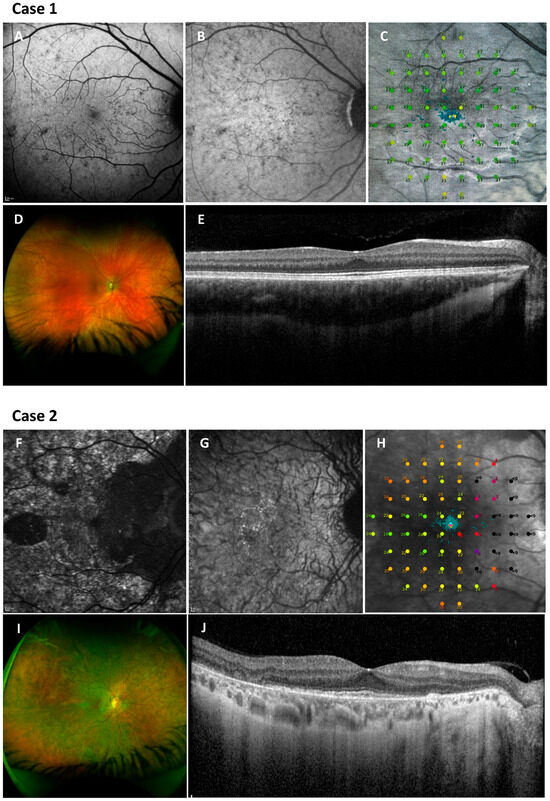 Retinal Patterns and the Role of Autofluorescence in Choroideremia