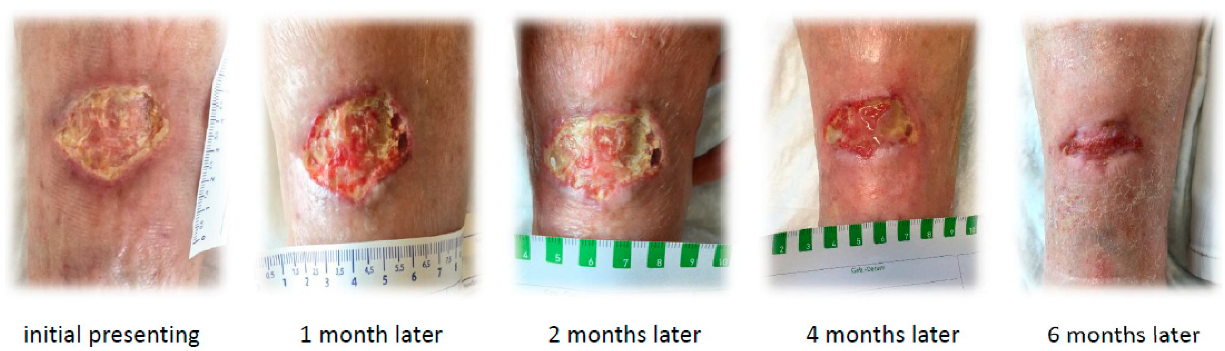calciphylaxis patient education