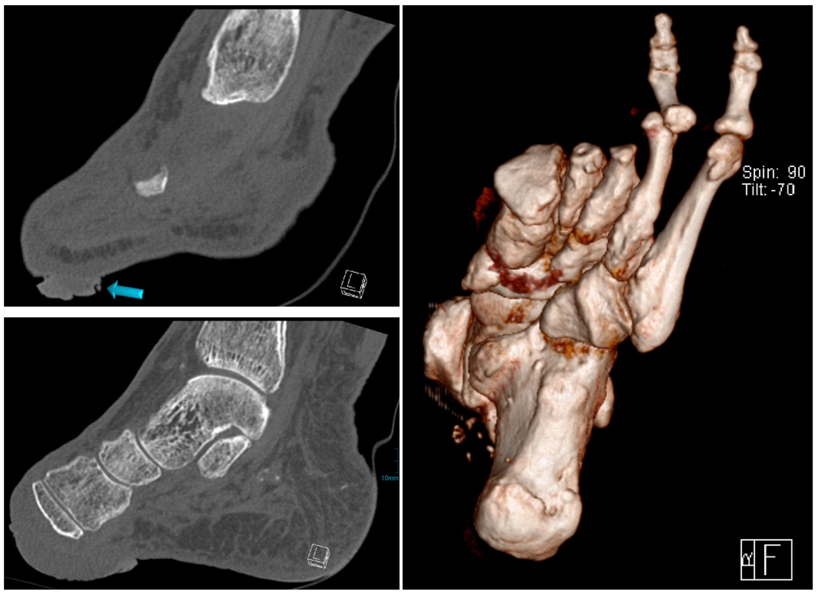 Geriatrics Free FullText Malignant Transformation in Diabetic Foot