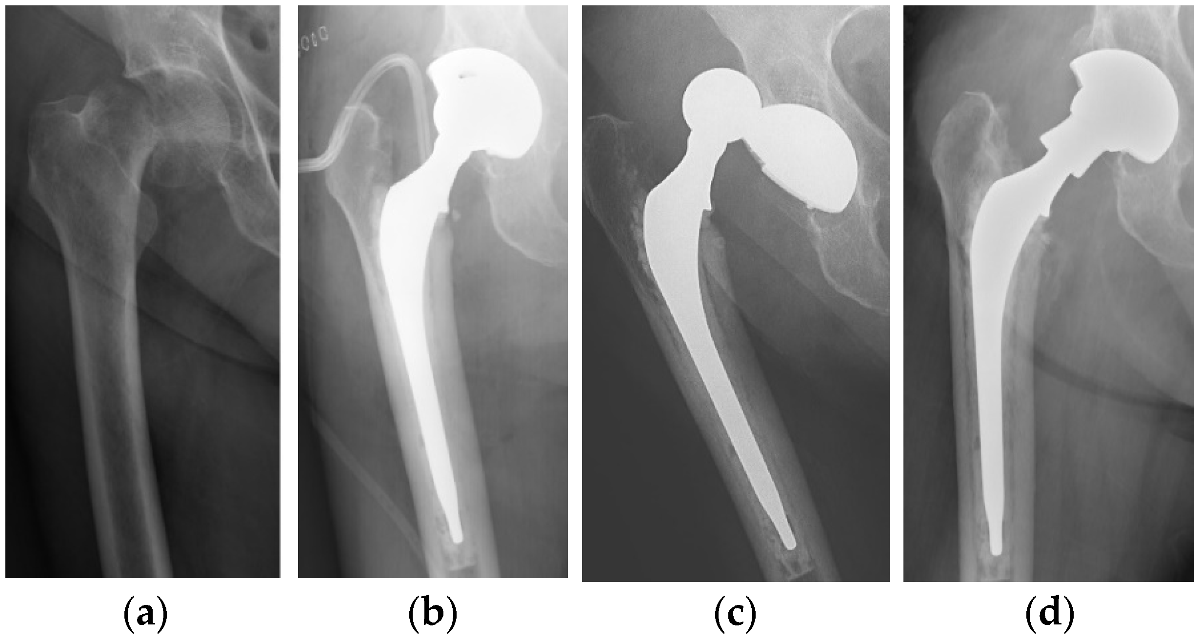 Bipolar Hemiarthroplasty Vs Total Hip Replacement