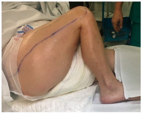 Neglected Dislocation in Adults A New Therapeutic Strategy for an Uncommon Condition