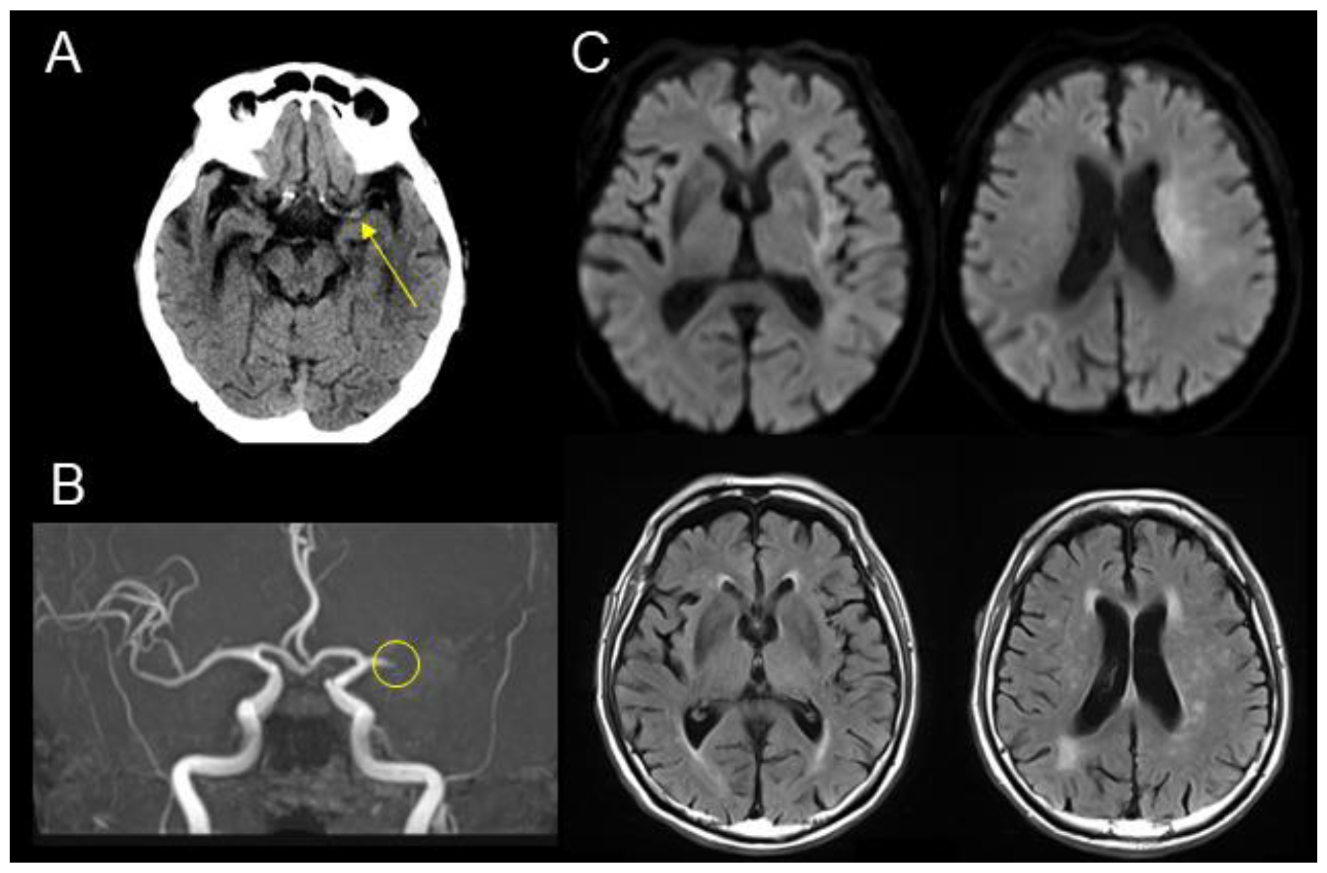 Diffusion MRI Fiber Tractography and Benzodiazepine SPECT