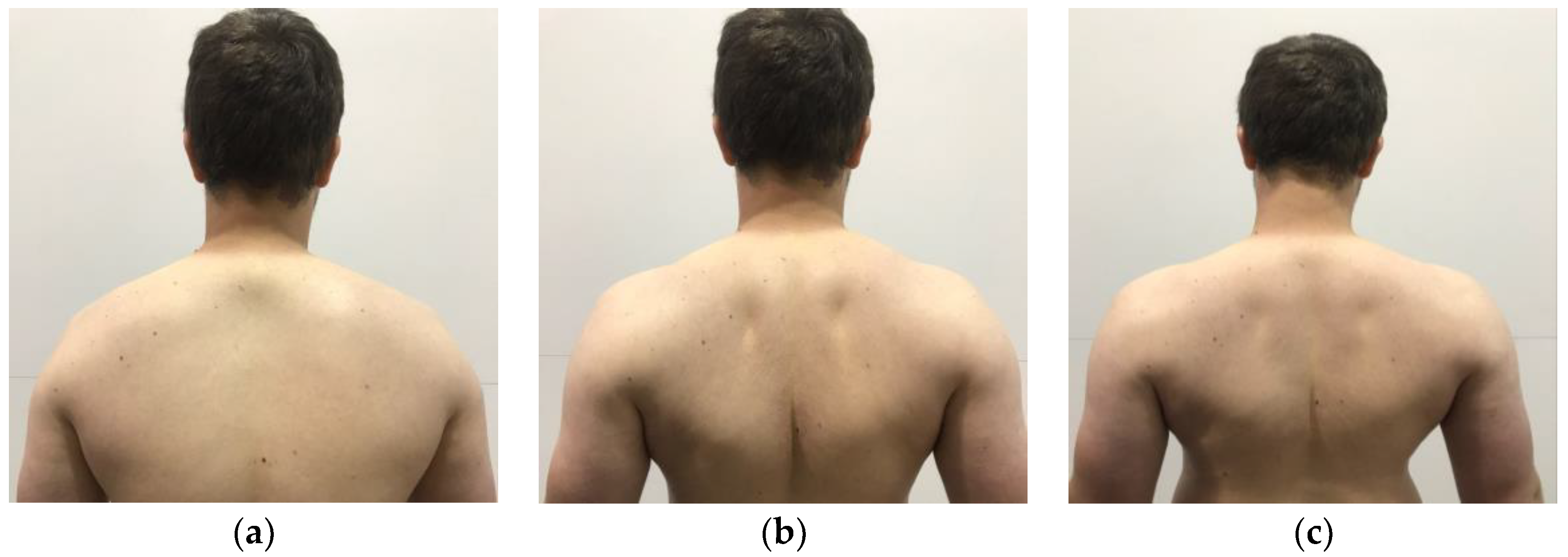Healthcare | Free Full-Text | Thoracic Outlet Syndrome: Biomechanical and  Exercise Considerations