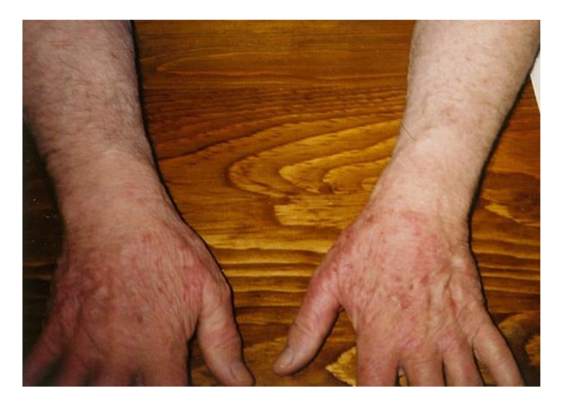 Healthcare | Free Full-Text | Presentation of Acrodermatitis Chronica