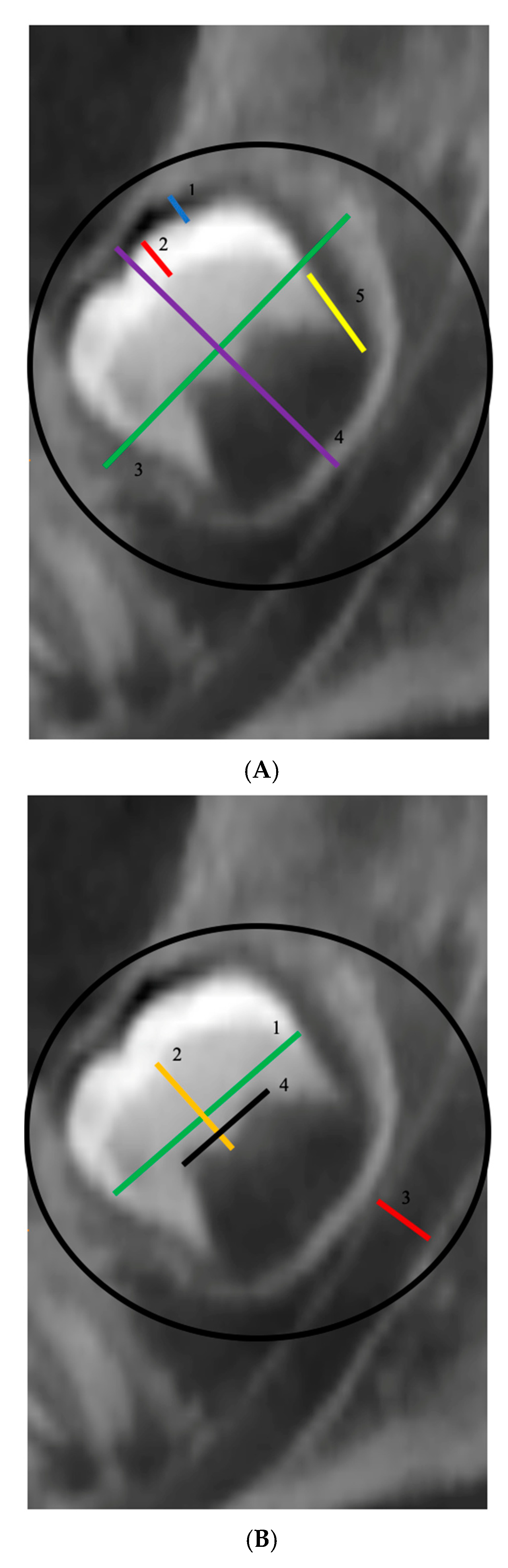 Healthcare Free Full Text The Characteristics Of Adjacent Anatomy Of Mandibular Third Molar Germs A Cbct Pilot Study In Patients With Osteogenesis Imperfecta Html