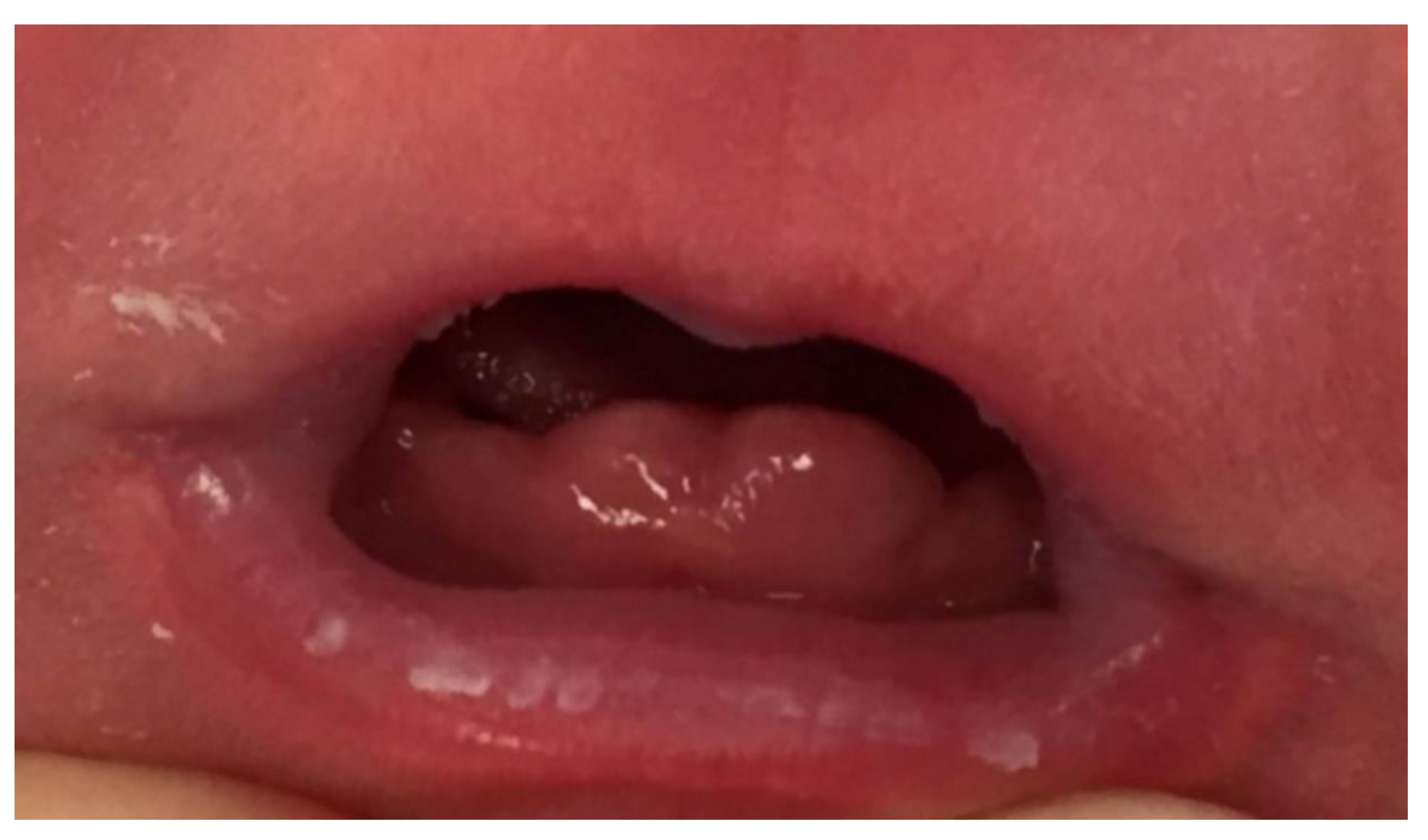 Neonatal teeth
